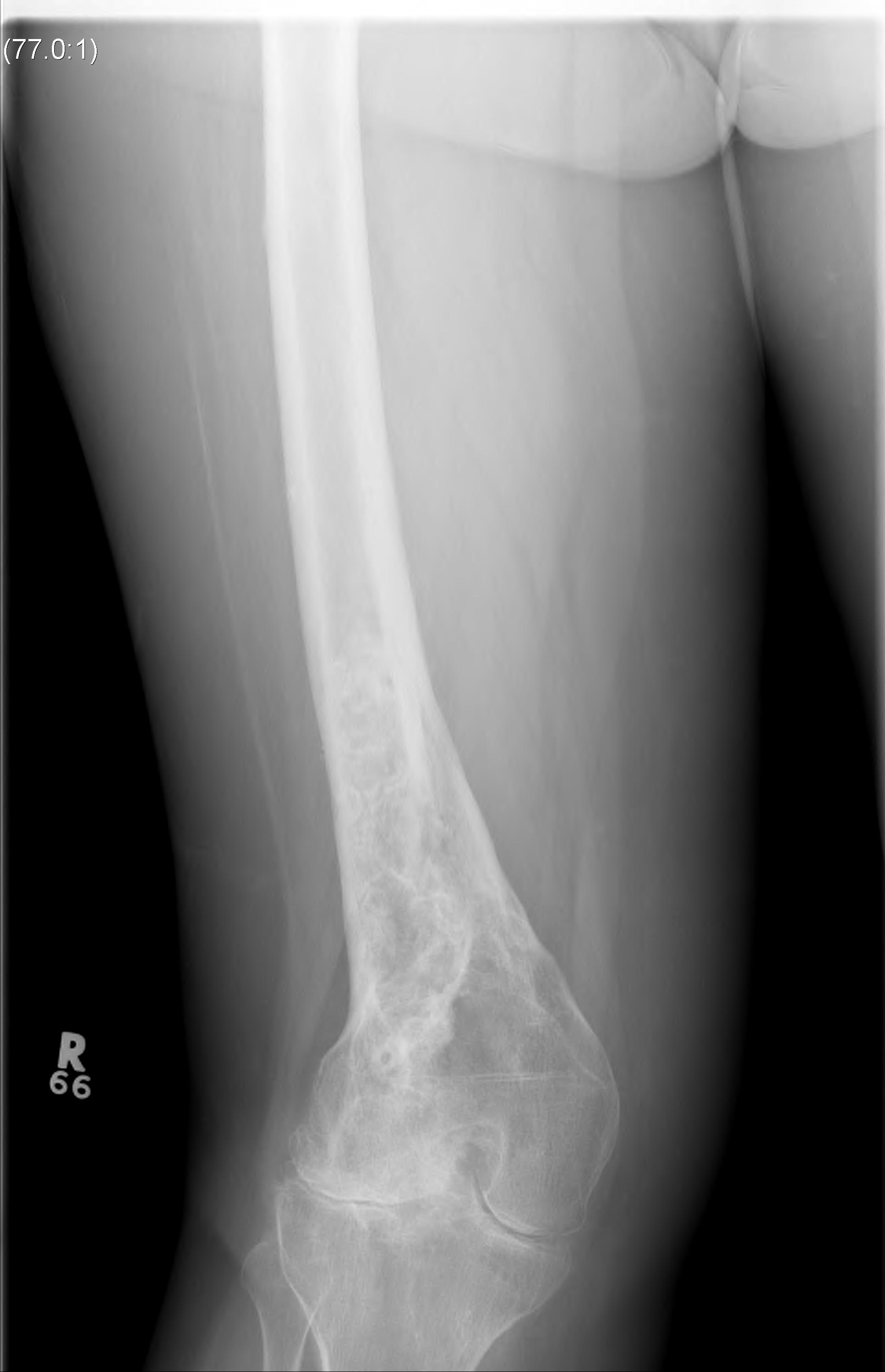 Previous Unicondylar Fracture 3